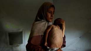 Un cuarto de los ni&ntilde;os peque&ntilde;os de Gaza sufren de malnutrici&oacute;n, afirma MSF