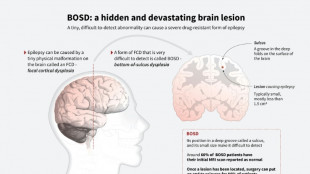 AI tool helps researchers treat child epilepsy
