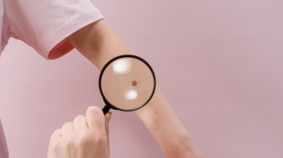 Il 70% dei melanomi nasce da nei nuovi, cruciale l'osservazione